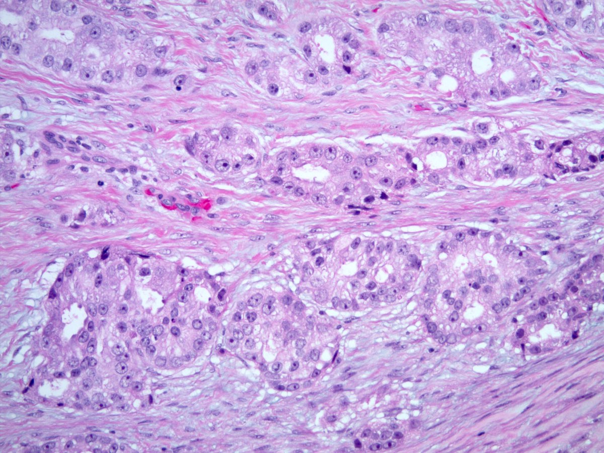 Prostate Cancer Gleason  challenge: 3+3,  3+4 or higher?:  kikoxp.com/posts/24552