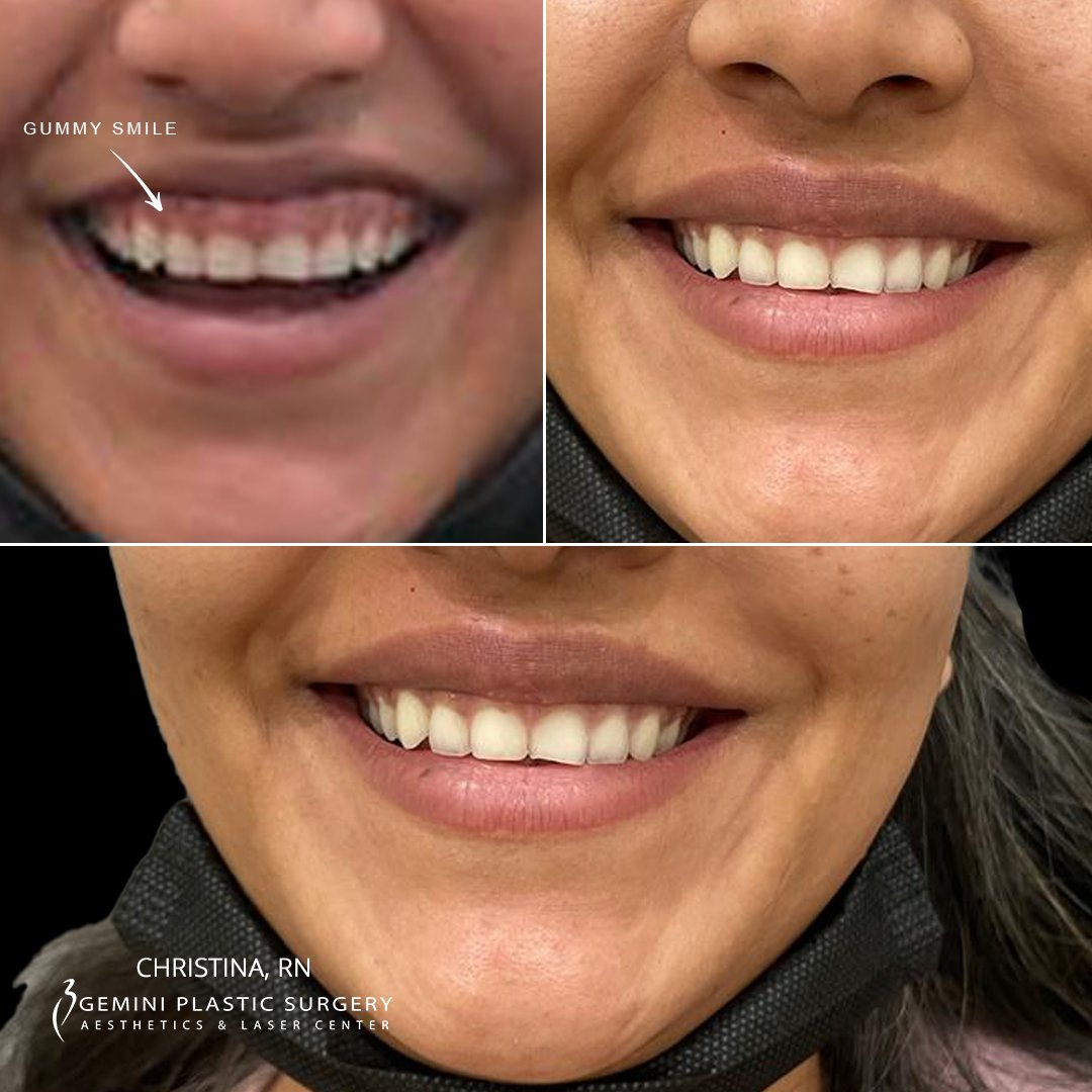_ChristinaRN's tweet photo. Botox for #GummySmile #001-20

How long does gummy smile #Botox take to work?
The treatment takes around 72 hours to begin working and 2 weeks for the effects to be fully realized, although you may feel most of the effect after 7 to 10 days.

Book Christina, RN! https://t.co/ZMPs4ufrmN