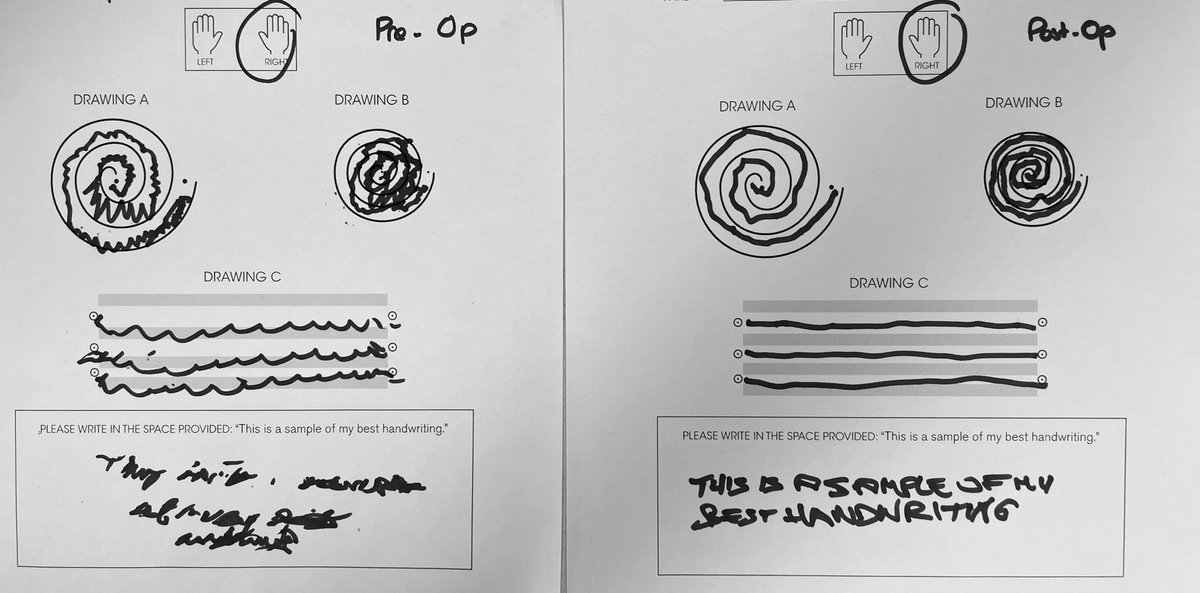 Before and after focused ultrasound for 1) tremor-dominant Parkinson’s disease and 2) dystonic tremor. Slightly different targets but great outcomes in both! #fus #hifu #tremor #learnsomethingnew @NeurosurgUCSF @UCSFimaging @UCSFHospitals