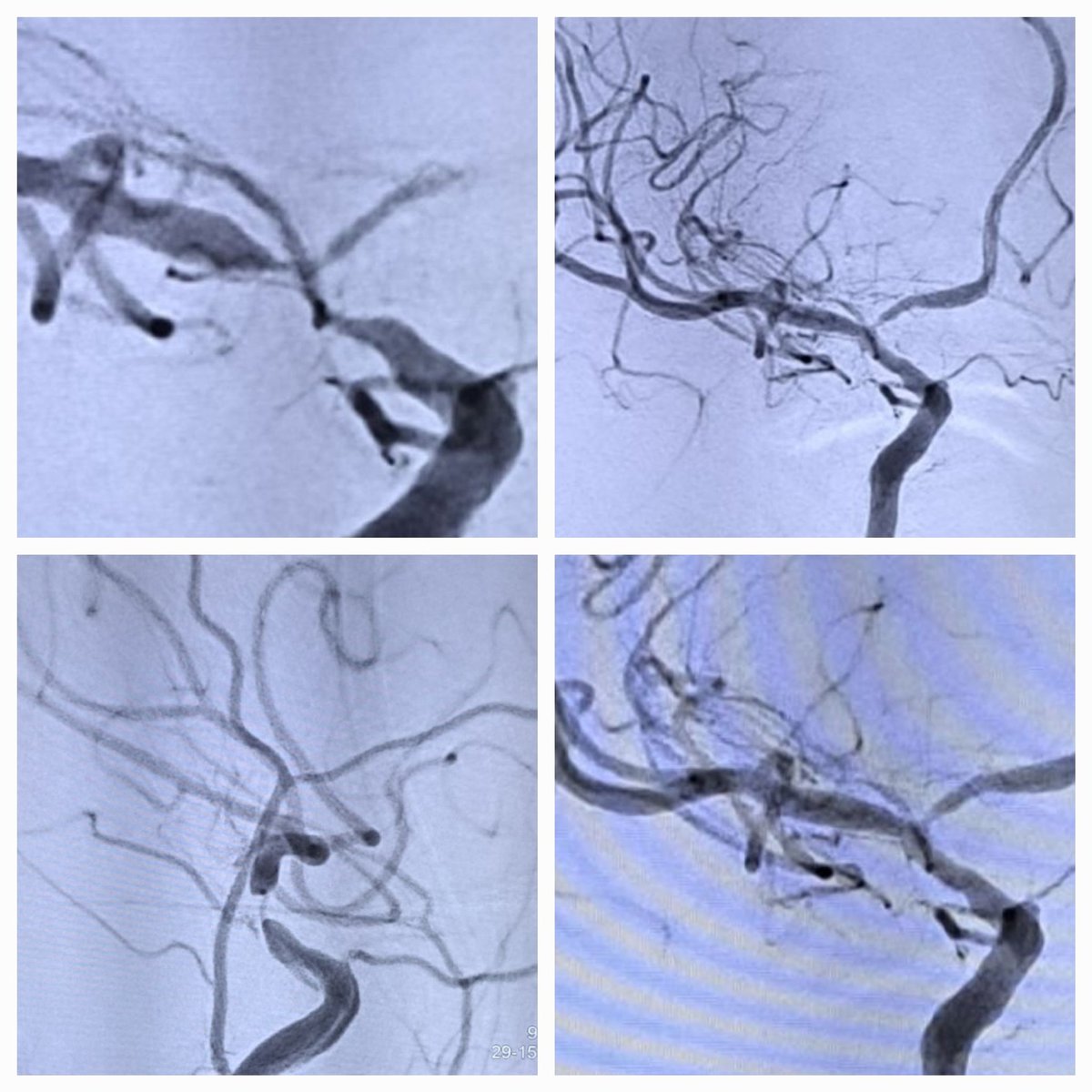 NandedStroke's tweet photo. Stroke Survivor. Carotid supraclinoid T stenosis, simple balloon angioplasty. No further TIAs. #strokeawareness #professor #medicine #institutes #doctor #HealthForAll #Ruralhealth #publichealth https://t.co/JWfUJfDSkw