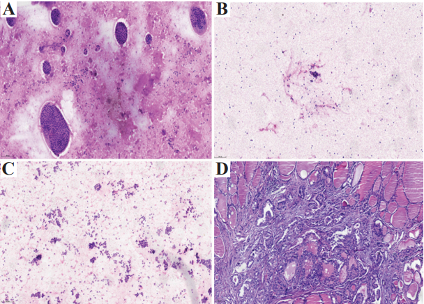 Cancer_Whioce's tweet photo. Welcome to read this article from Cancer Plus. 🤗Combined Application of Fine-Needle #Aspiration #Cytology with #BRAFV600E Mutation Screening in the Detection of Different Grades of Papillary #Thyroid #Carcinoma

See more detail at: 👇👇
https://t.co/VEXlq8ppuv https://t.co/b53rWngbWg