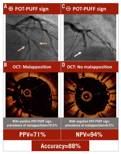 "The POT-PUFF sign: an angiographic mark of stent malapposition during proximal optimisation". A Research Correspondence by Aminfar F, et al. #EAPCI  ow.ly/B94y50NWe9W