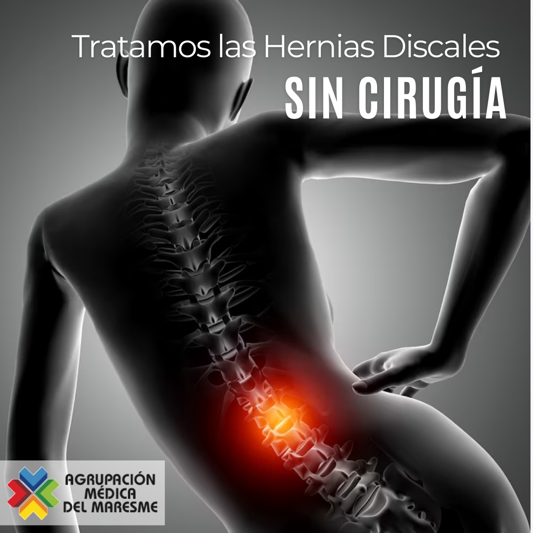 Inst_TraumaBCN's tweet photo. Si estás sufriendo de hernias discales, no tienes que resignarte al dolor o pasar por el quirófano. El Dr. Kirchner es un #traumatólogo reconocido, especializado en tratar las #hernias discales sin cirugía, aliviando el dolor y mejorando la calidad de vida de los pacientes. https://t.co/lV3CKXlXN3