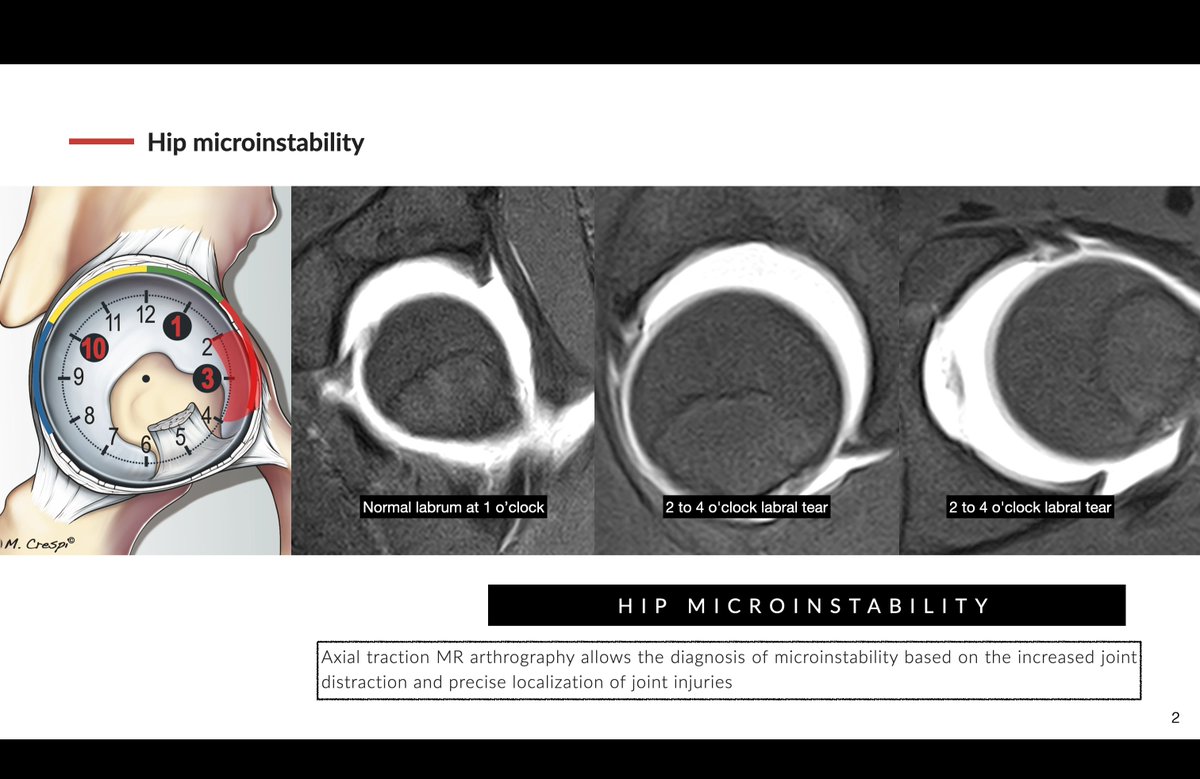 MR arthrography with axial traction. Chondrolabral injuries in hip microinstability have a different location than typical FAI injuries, which are located in the anterosuperior quadrant. They are predominantly located in the anterior quadrant, centered at 3 o'clock