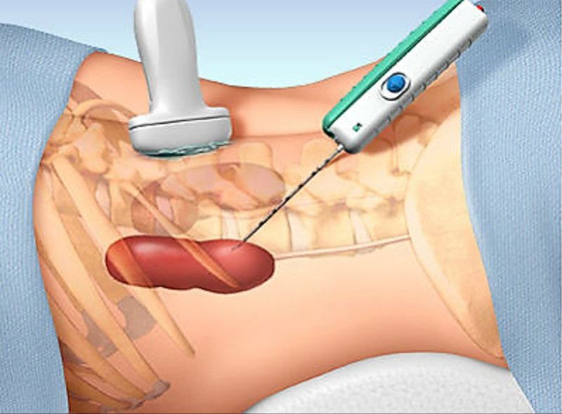 Nephrol00976063's tweet photo. A percutaneous renal biopsy is an essential tool used for diagnosis, prognosis, and guiding the management of many glomerular diseases
#kidneybiopsy #glomerulardiseases 
To view more: https://t.co/EFv4Ul1Eh7 https://t.co/zpMe7p6IJK