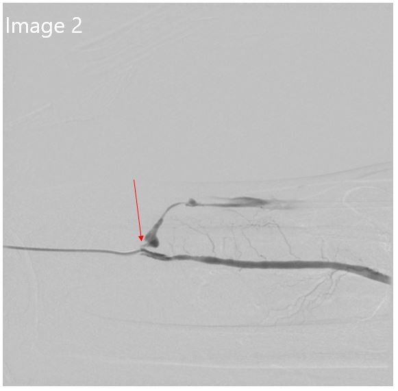 cirsesociety's tweet photo. 3. After failed attempt to perform retrograde recanalization, a distal radial arterial puncture was performed, &amp; anastomotic stenosis was confirmed. Rendezvous w/ the venous side was performed &amp; then angioplasty (3,4 &amp; 5 mm) through the venous access was performed... https://t.co/R6YjDRPi7T