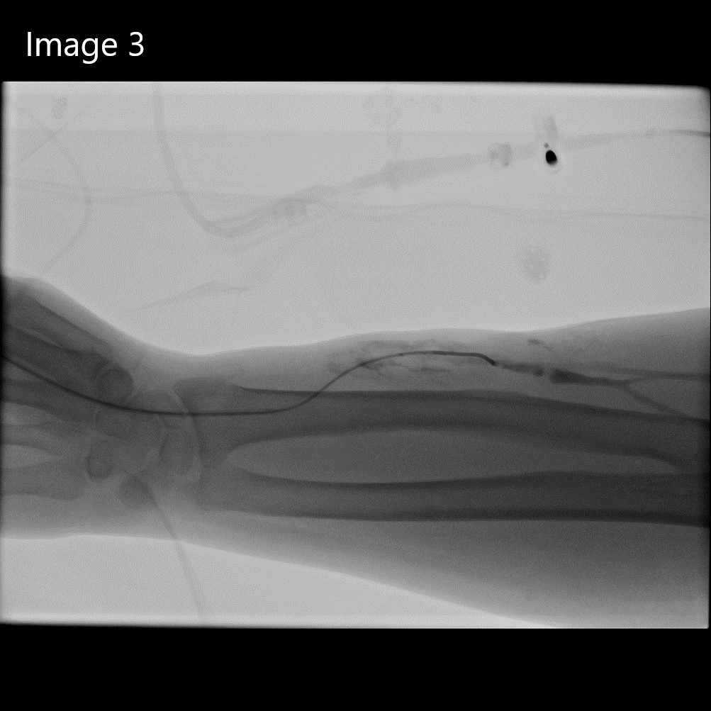cirsesociety's tweet photo. 3. After failed attempt to perform retrograde recanalization, a distal radial arterial puncture was performed, &amp; anastomotic stenosis was confirmed. Rendezvous w/ the venous side was performed &amp; then angioplasty (3,4 &amp; 5 mm) through the venous access was performed... https://t.co/R6YjDRPi7T