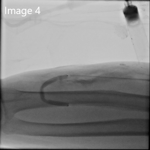 cirsesociety's tweet photo. 3. After failed attempt to perform retrograde recanalization, a distal radial arterial puncture was performed, &amp; anastomotic stenosis was confirmed. Rendezvous w/ the venous side was performed &amp; then angioplasty (3,4 &amp; 5 mm) through the venous access was performed... https://t.co/R6YjDRPi7T