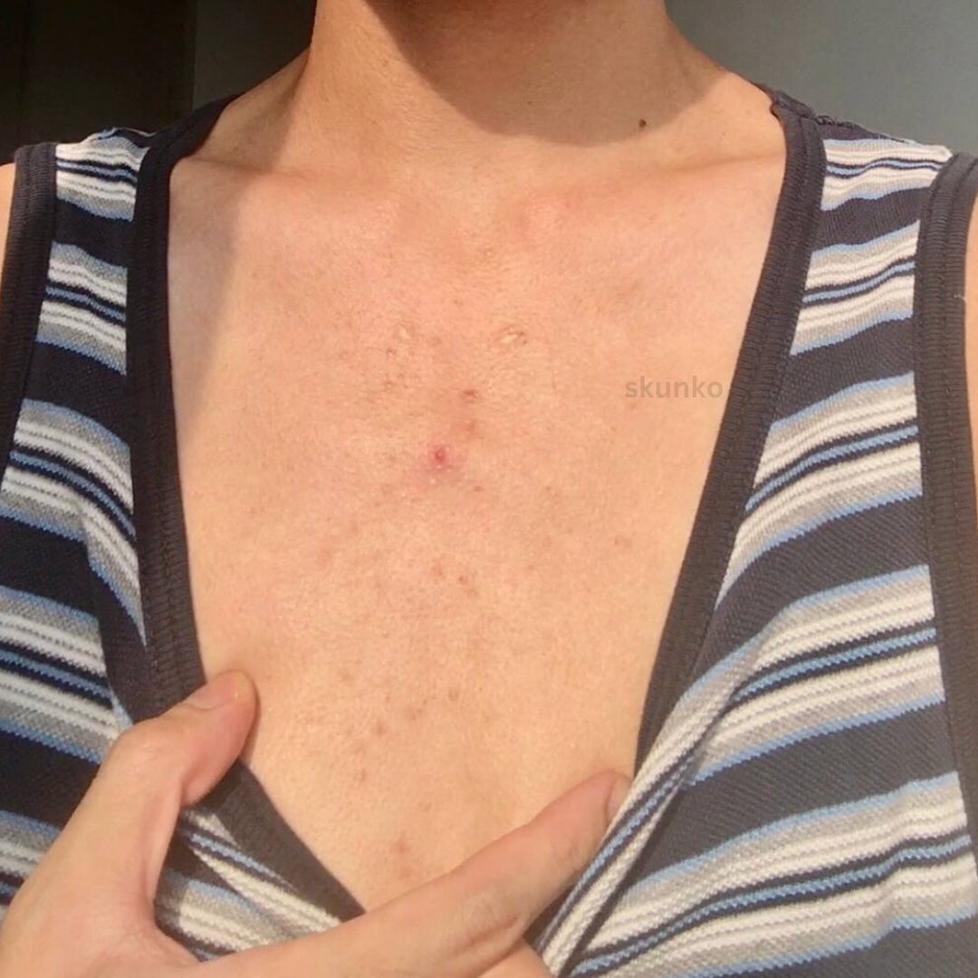 secretlyfura's tweet photo. Here are some simple steps you could do to solve any jerawat badan, dada and bontot issue! 💯proven works! 

• Once peluh badan kering, terus mandi and wear clean clothes. https://t.co/S9BNfL1Uad