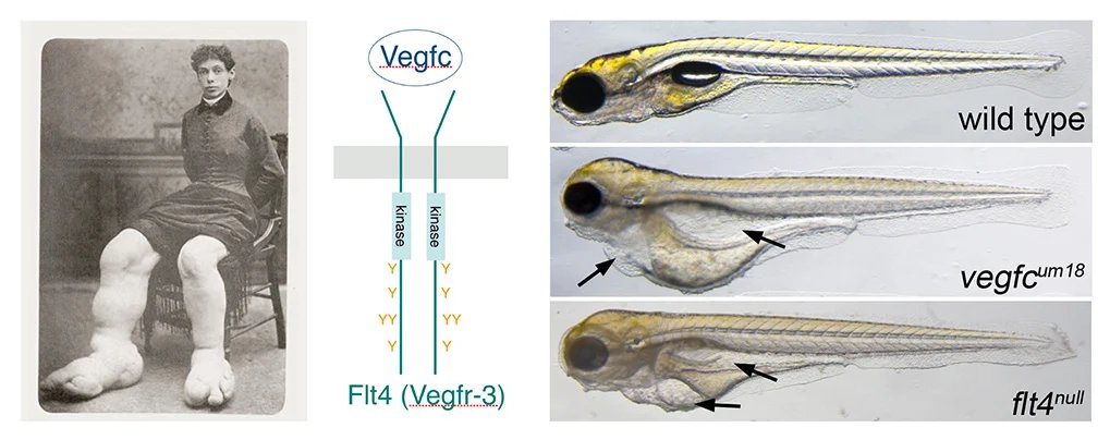 ZebrafishRock's tweet photo. Humans and #zebrafish carrying mutations in VEGFC or its receptor (FLT4) have defects in the formation of their lymphatic systems, which are important for draining lymph back into the circulation system.  As a result, these individuals display severe #lymphedema. #KnowYourZDM https://t.co/JlHu9qXRxF