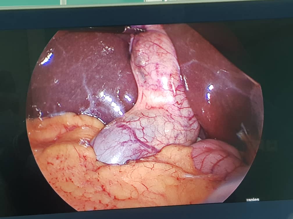 SaraSaeidi92's tweet photo. A rare case of "Gallbladder Duplication", V shaped! Prevalence: 1 in 3800-4000 births. 💫💫
By my dear friend Dr.@David_black70 👍
@SAGES_Updates @ACPGBI_EduTrain @Cirbosque @BJSAcademy @PipeCabreraV  @hpb_so @me4_so #SurgicalTraining #SoMe4Surgery #Gallbladder https://t.co/3pMihBv0Yp