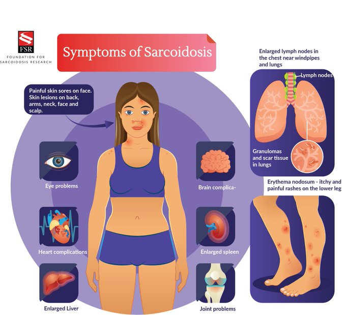 Did you know that signs #sarcoidosis vary widely depending on the organs affected? While many people who have sarcoidosis have very few or no signs of the disease, others suffer debilitating effects that can interfere with daily life.

@StopSarcoidosis @GlobalGenes @EveryLifeOrg