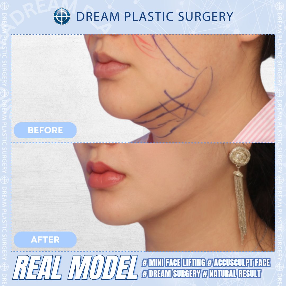 dreamprs_eng's tweet photo. #plasticsurgery #dreamplasticsurgery #rhinoplasty #nosejob #nosesurgerys #koreanplasticsurgery #koreaplasticsurgeryreview #beforeandafter #koreaplasticsurgerybeforeandafter #surgerybeforeandafter #beforeandafterchallenge #prettygirls #facelifting #antiageing #facelift #oldyoung https://t.co/TnmwZlsyOE