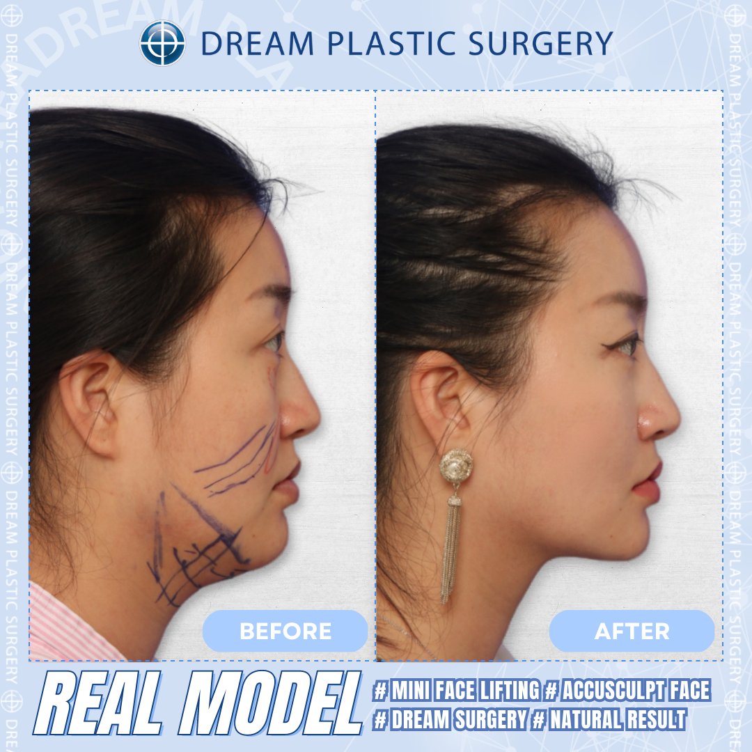 dreamprs_eng's tweet photo. #plasticsurgery #dreamplasticsurgery #rhinoplasty #nosejob #nosesurgerys #koreanplasticsurgery #koreaplasticsurgeryreview #beforeandafter #koreaplasticsurgerybeforeandafter #surgerybeforeandafter #beforeandafterchallenge #prettygirls #facelifting #antiageing #facelift #oldyoung https://t.co/TnmwZlsyOE
