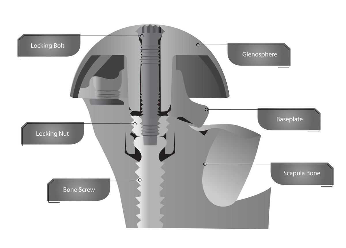 GenesisGroup_MI's tweet photo. Shoulder Innovations Announces Additional Patent for InSet™ Reverse Shoulder System

https://t.co/AqAKfJWftT https://t.co/fONixpsPlG