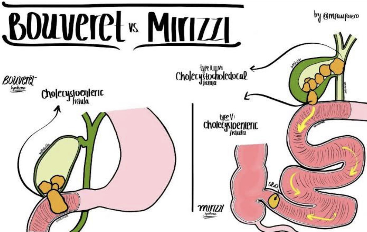 🪨 Bouveret’s versus 🆚 🪨 Mirizzi By ⁦@mpauforero⁩