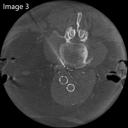 cirsesociety's tweet photo. The patient was in a prone position, and mild sedation was performed. Using a combination of fluoroscopy and cone beam CT, the aneurysmatic sac was punctured using a 21 G needle. (Image 3)  Afterward, a 6F coaxial system was advanced. (Image 4) (4/7) https://t.co/o3DpuyMYVB