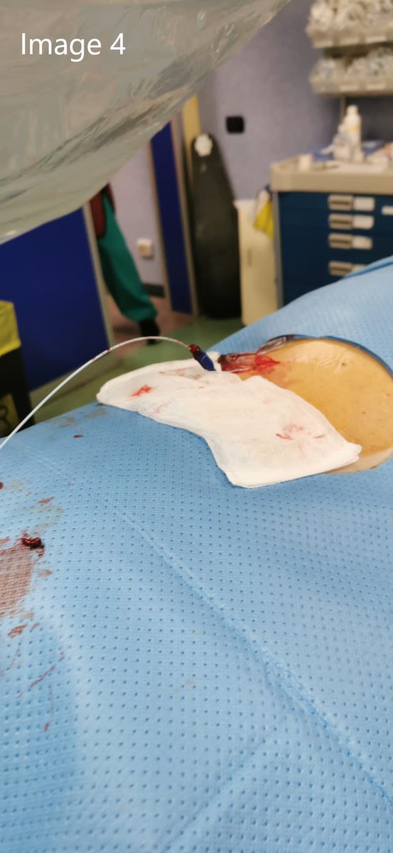 cirsesociety's tweet photo. The patient was in a prone position, and mild sedation was performed. Using a combination of fluoroscopy and cone beam CT, the aneurysmatic sac was punctured using a 21 G needle. (Image 3)  Afterward, a 6F coaxial system was advanced. (Image 4) (4/7) https://t.co/o3DpuyMYVB
