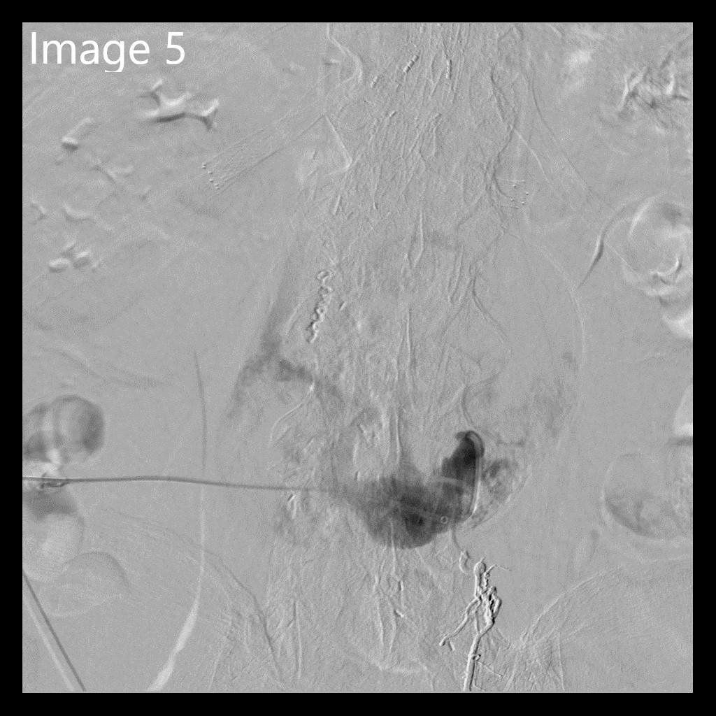 cirsesociety's tweet photo. Angiography confirms type II endoleak from lumbar arteries. (5/7) https://t.co/QOk7OTtp4B