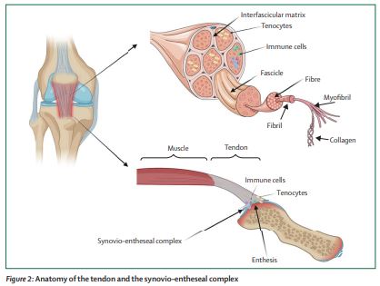 The Lancet Rheumatology (@thelancetrheum) on Twitter photo NEW REVIEW—<a href="/lindsaycrowe91/">Lindsay Crowe</a> and colleagues discuss the parallels between #tendinopathy and #enthesitis thelancet.com/journals/lanrh…
<a href="/TendonGlasgow/">Neal L Millar</a> <a href="/moeed_akbar/">Moeed Akbar</a> <a href="/rj_devos/">Robert-Jan de Vos</a> <a href="/pdkirwan/">Dr Paul Kirwan</a> <a href="/carlespedret/">carlespedret</a> <a href="/IainBMcInnes1/">Iain B. McInnes</a> <a href="/StefanSiebert1/">Stefan Siebert</a> NEW REVIEW—<a href="/lindsaycrowe91/">Lindsay Crowe</a> and colleagues discuss the parallels between #tendinopathy and #enthesitis thelancet.com/journals/lanrh…
<a href="/TendonGlasgow/">Neal L Millar</a> <a href="/moeed_akbar/">Moeed Akbar</a> <a href="/rj_devos/">Robert-Jan de Vos</a> <a href="/pdkirwan/">Dr Paul Kirwan</a> <a href="/carlespedret/">carlespedret</a> <a href="/IainBMcInnes1/">Iain B. McInnes</a> <a href="/StefanSiebert1/">Stefan Siebert</a>