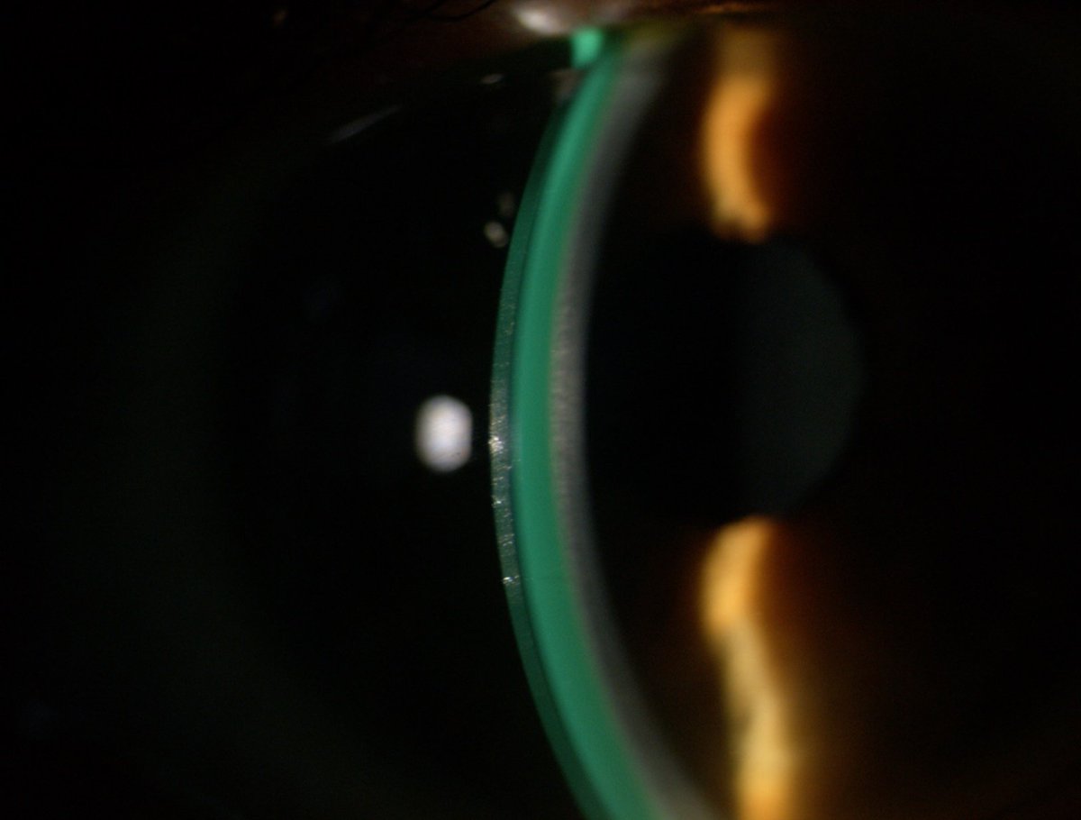 mrj_vision's tweet image. This week we had a session on mini-scleral lenses from @MeniconUK for our final year @PlymOptometry students. It was great to see their enthusiasm and skill to fit and assess the lenses.
Thanks to Josie, James and Hans from @Meniconuk for running these sessions.