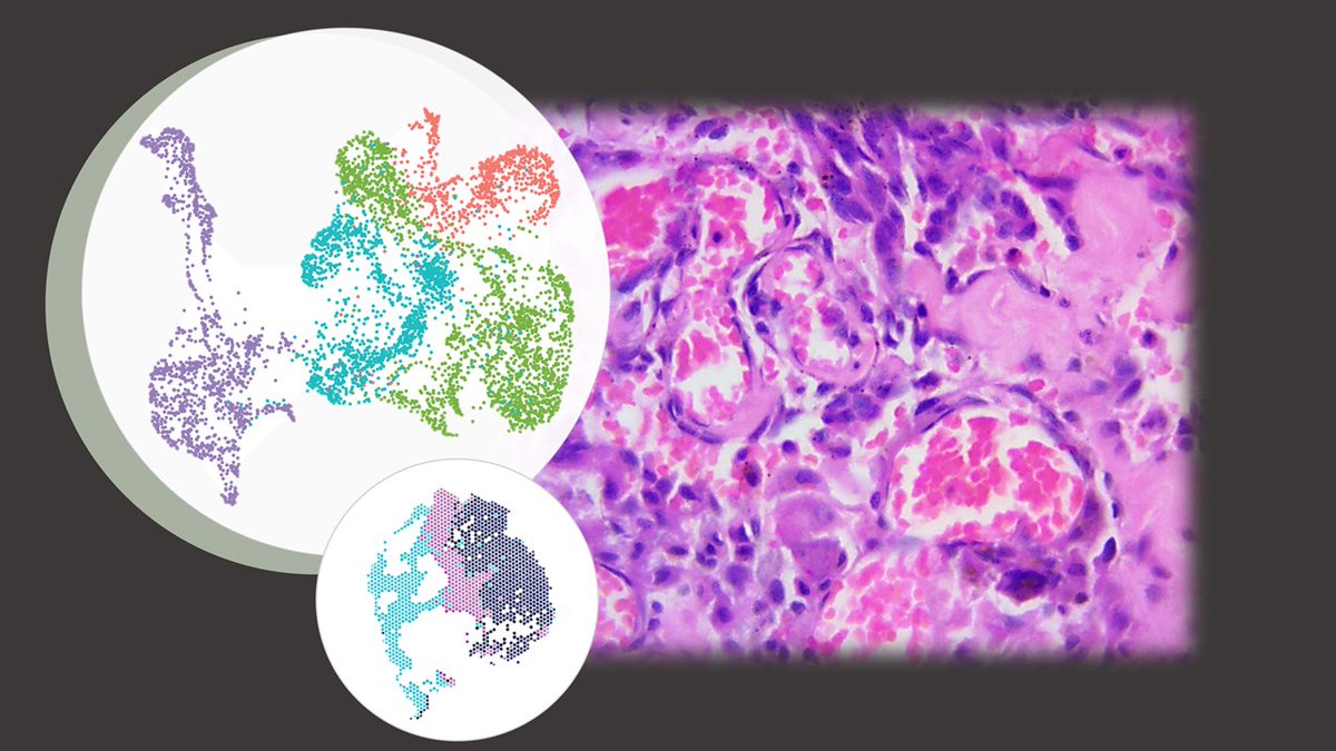 A spatial transcriptomic and genomic analysis of angiosarcomas, including samples from the head and neck region, reveal the tumor immune landscape of this cancer. <a href="/DrJasonChan_SG/">Jason Y. Chan</a>
doi.org/10.1038/s42003…