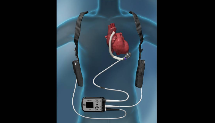 While patients with severe #heartfailure await a #hearttransplant, cardiologists and #heart surgeons sometimes will recommend a left ventricular assist device (or #LVAD).

❤️➡️ Cedric Sheffield, MD explains more: bit.ly/3oO6s22 <a href="/MiamiHerald/">Miami Herald</a> 

#DonateLifeMonth