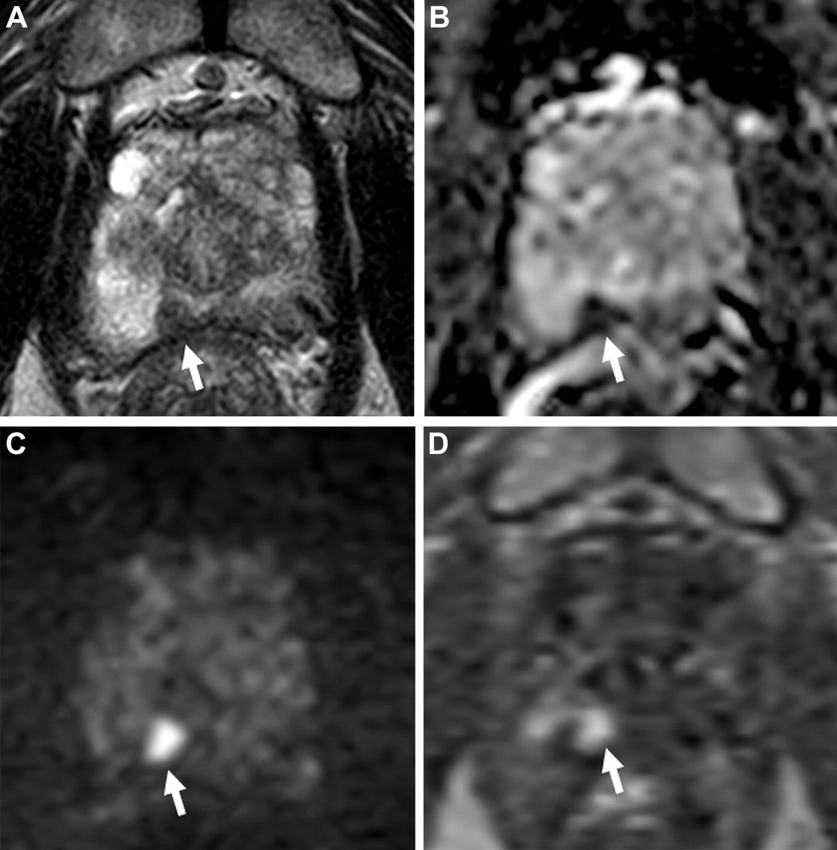 Radiology (@radiology_rsna) on Twitter photo "PI-RADS: Where Next?" Risk prediction models, quantitative MRI methods, and AI may improve the performance of PI-RADS. <a href="/radiolobt/">Baris Turkbey MD</a> <a href="/Purysko/">Andrei Purysko</a> bit.ly/3Aq66l1 "PI-RADS: Where Next?" Risk prediction models, quantitative MRI methods, and AI may improve the performance of PI-RADS. <a href="/radiolobt/">Baris Turkbey MD</a> <a href="/Purysko/">Andrei Purysko</a> bit.ly/3Aq66l1