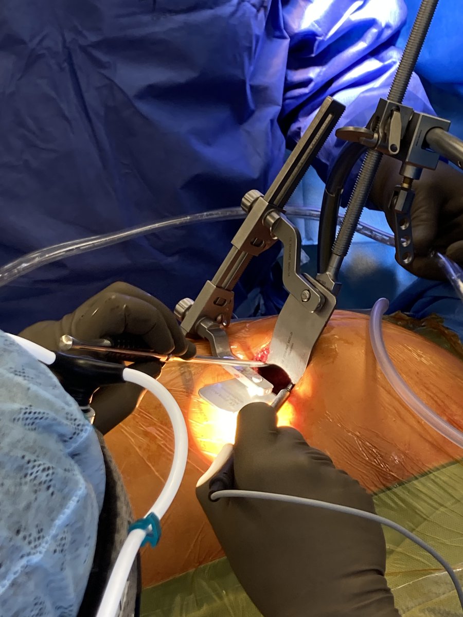 TulioCaldonazo's tweet image. 4-day result after MICS CABG using BIMA as composite graft.

✅ Anaortic
✅ Total-arterial
✅ Off-pump

#JenaUniversityHospital
#HeartSurgery
#MICS