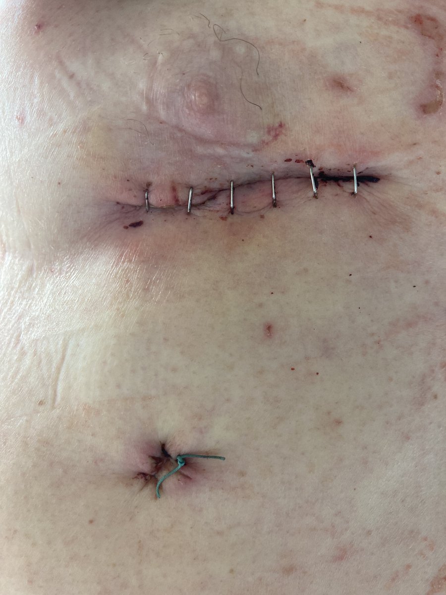 TulioCaldonazo's tweet image. 4-day result after MICS CABG using BIMA as composite graft.

✅ Anaortic
✅ Total-arterial
✅ Off-pump

#JenaUniversityHospital
#HeartSurgery
#MICS