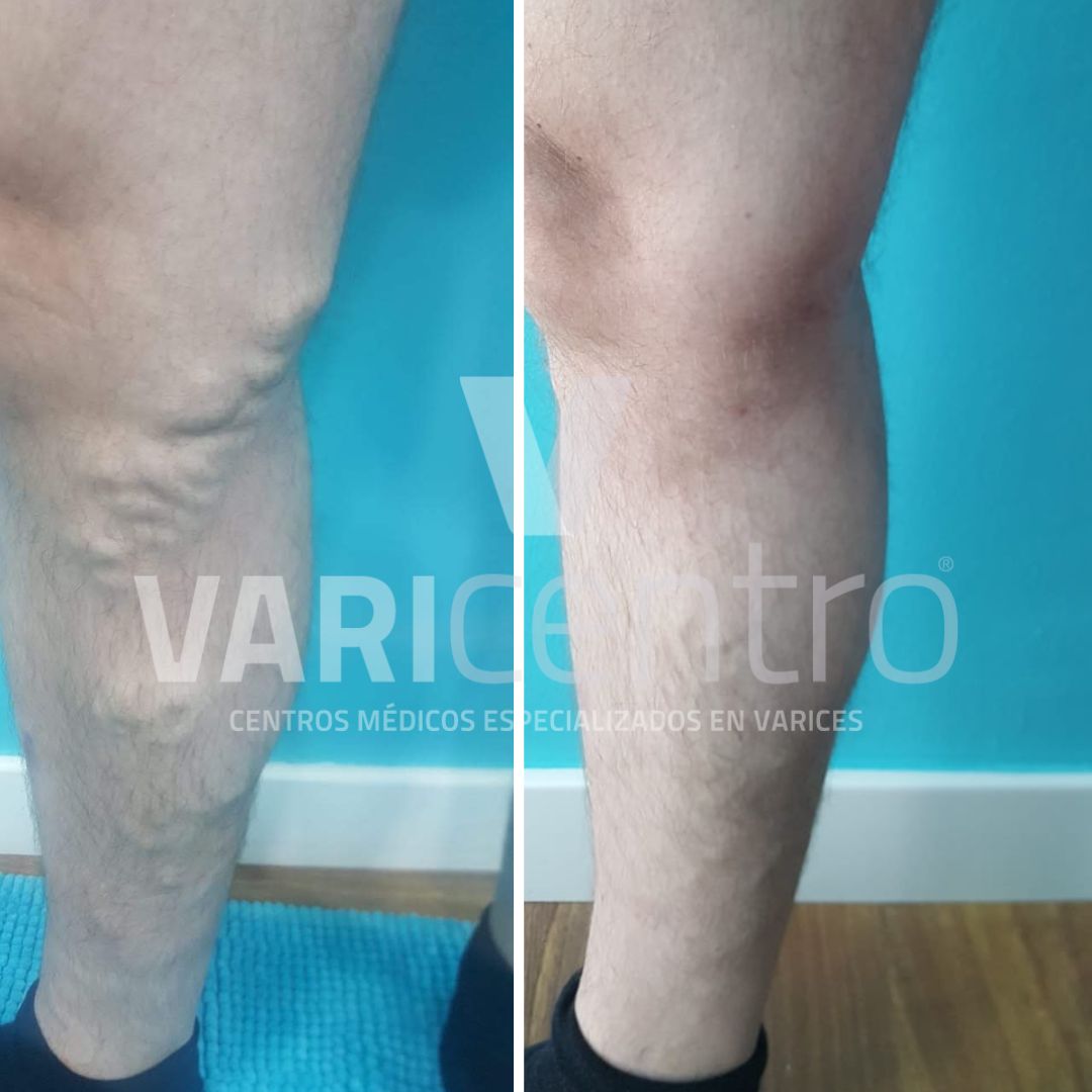 Varicentro's tweet photo. Una imagen vale más que mil palabras. Aquí os dejamos las fotos del antes y después del tratamiento con espuma esclerosante de un paciente.
Si quieres más información puedes contactar con nosotros en
☎️ 912 77 88 99
🖥 https://t.co/gstaJ3A2qv
#Varicentro #varices https://t.co/mX9GmbvqHO