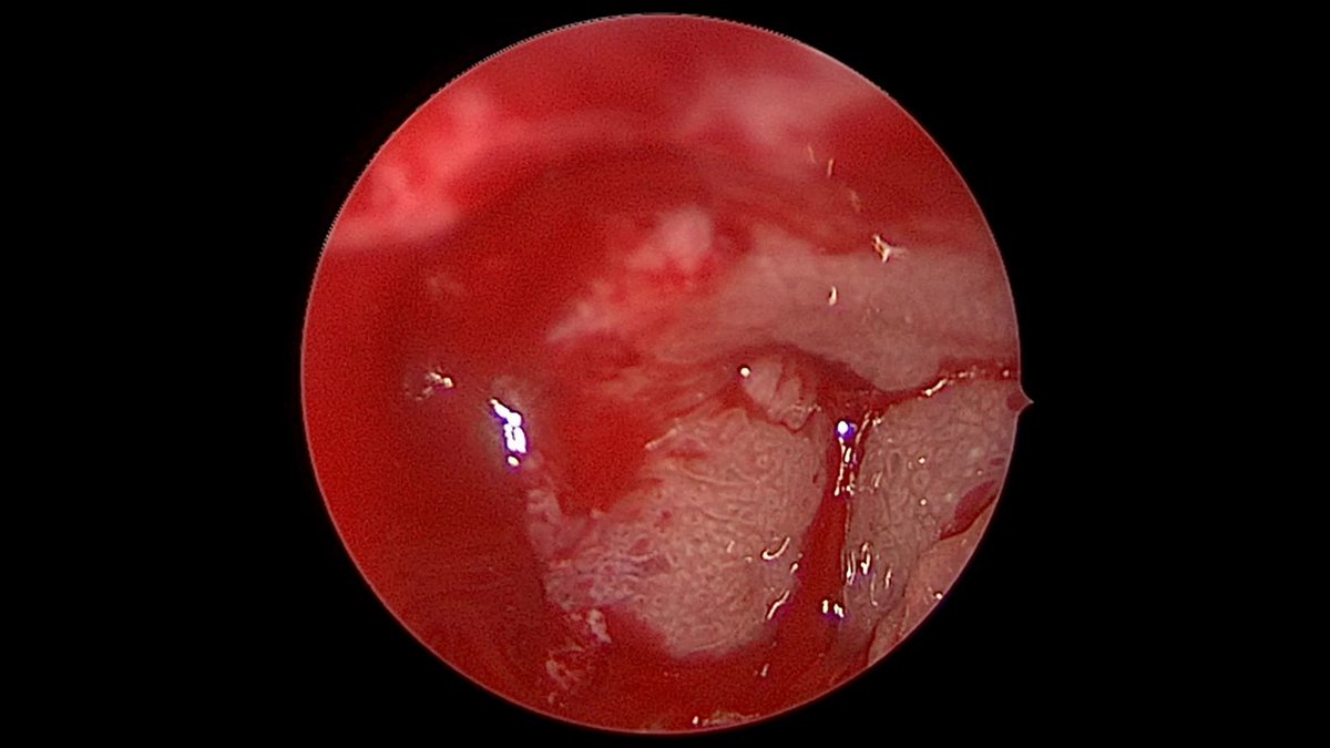 John Craig, MD (@johncraignose) on Twitter photo Yet another #ODS case. Pt had a bone graft plus dental implant in 2021. Was told the bone graft might work its way out of the sinus. Well, it didn't. Lived with sinusitis for a couple yrs. At least the implant is stable, and shouldn't need it removed. <a href="/henryfordent/">Henry Ford ENT</a> <a href="/ent_ams/">Alberto Maria Saibene, MD, MA</a> Yet another #ODS case. Pt had a bone graft plus dental implant in 2021. Was told the bone graft might work its way out of the sinus. Well, it didn't. Lived with sinusitis for a couple yrs. At least the implant is stable, and shouldn't need it removed. <a href="/henryfordent/">Henry Ford ENT</a> <a href="/ent_ams/">Alberto Maria Saibene, MD, MA</a>