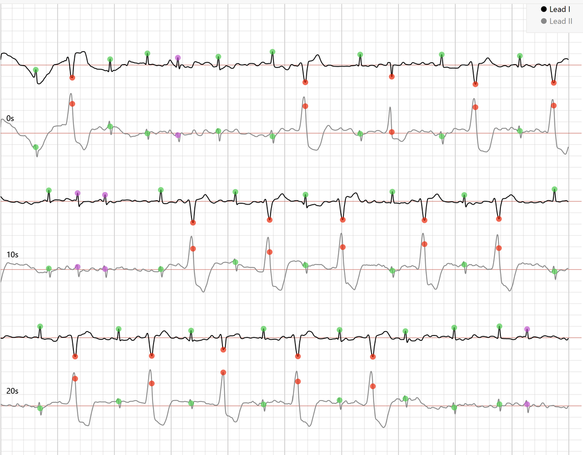 David E Albert M D On Twitter Rhythm Strip From AliveCor This Is A david-e-albert-m-d-on-twitter-rhythm-strip-from-alivecor-this-is-a