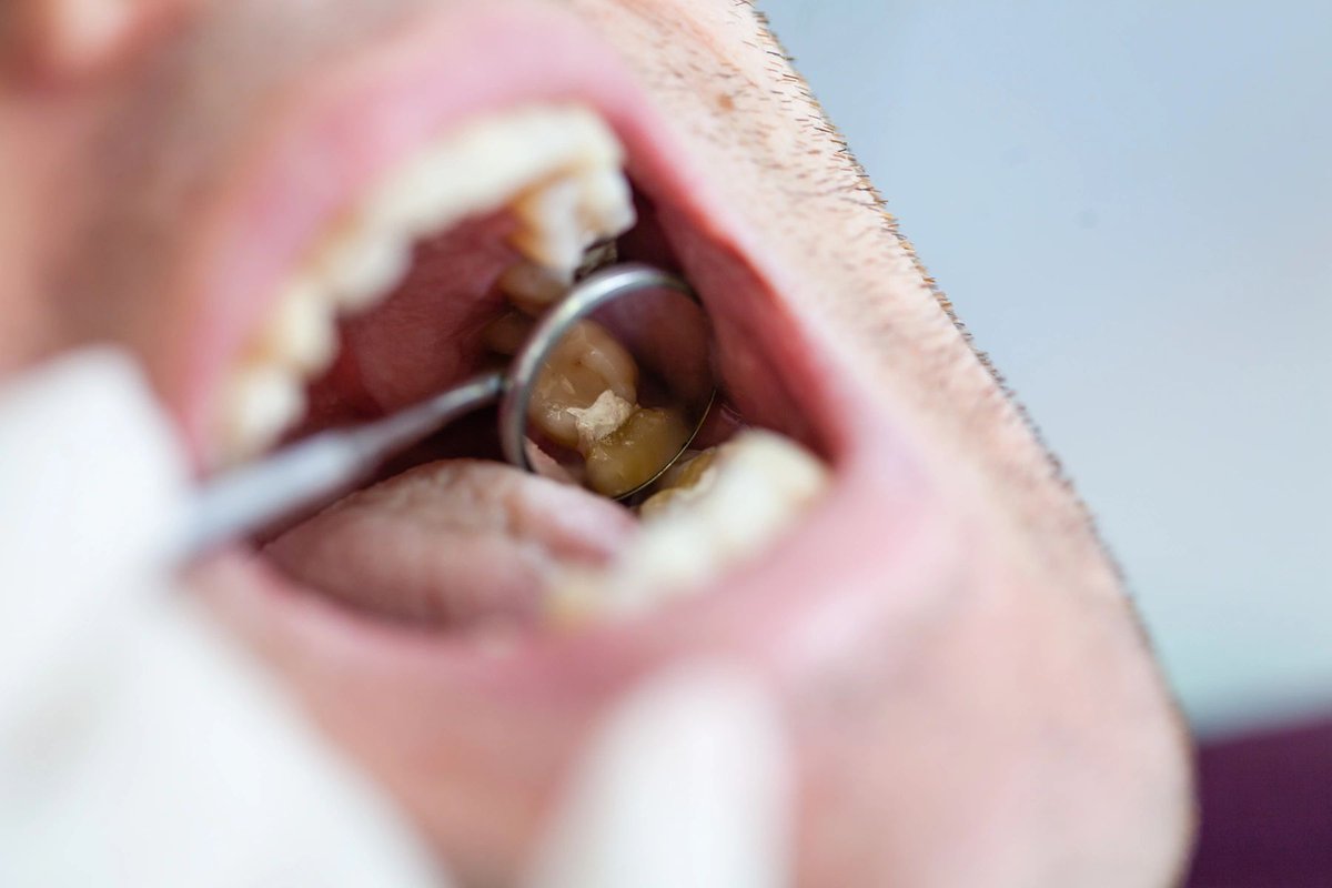 sandquistdds's tweet image. A healthy oral microbiome is one where good bacteria can thrive over bad bacteria. A strong oral microbiome can be achieved through a healthy diet, regular brushing, and routine dentist visits.