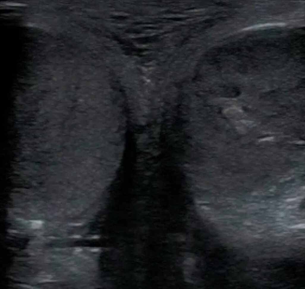 RutgersPOCUS's tweet photo. Scrotal sono to r/o torsion:
- linear high-frequency probe
- both testes side-by-side ('buddy shot')
- power doppler to assesses low-flow vessel flow, turn up gain until you see artifact
- edema and change in echogenicity (vs normal homogenous pattern) can take 6+ hrs to develop https://t.co/jhsYf4ua2i