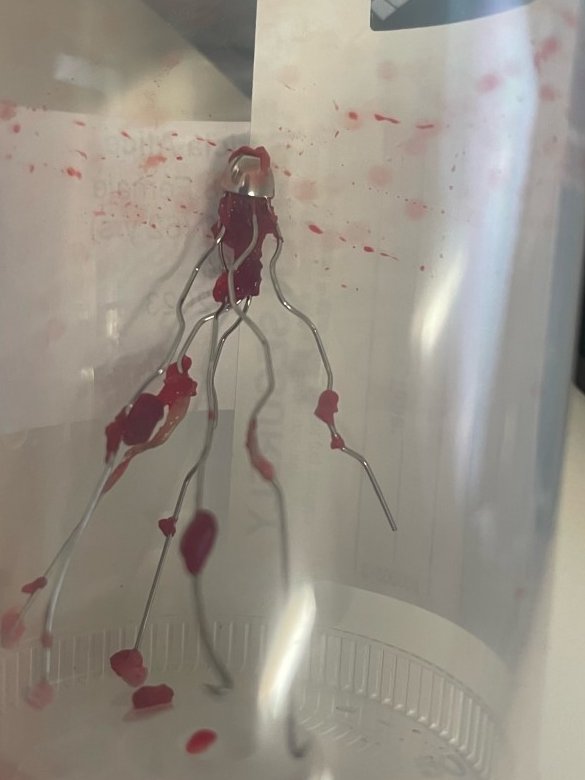 HageIRad's tweet photo. Satisfying to remove a filter that’s older than me! 😀Greenfield with strut perf into duodenum near ampulla, scarring causing biliary obstruction, embedded apex, removed with modified loop snare+ forceps+💪w/ @RobertFordMD @JeffCVIR  #filterout  @CHICKVIR https://t.co/qaDEUgQUW2