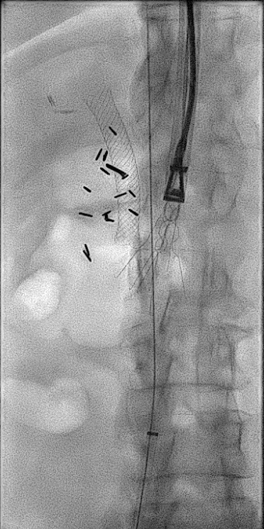 Anthony Hage, MD (@hageirad) on Twitter photo Satisfying to remove a filter that’s older than me! 😀Greenfield with strut perf into duodenum near ampulla, scarring causing biliary obstruction, embedded apex, removed with modified loop snare+ forceps+💪w/ <a href="/RobertFordMD/">Robert Ford, MD</a> <a href="/JeffCVIR/">Jefferson Interventional Radiology</a> #filterout <a href="/CHICKVIR/">Jeffrey F. B. Chick, MD, MPH</a> Satisfying to remove a filter that’s older than me! 😀Greenfield with strut perf into duodenum near ampulla, scarring causing biliary obstruction, embedded apex, removed with modified loop snare+ forceps+💪w/ <a href="/RobertFordMD/">Robert Ford, MD</a> <a href="/JeffCVIR/">Jefferson Interventional Radiology</a> #filterout <a href="/CHICKVIR/">Jeffrey F. B. Chick, MD, MPH</a>