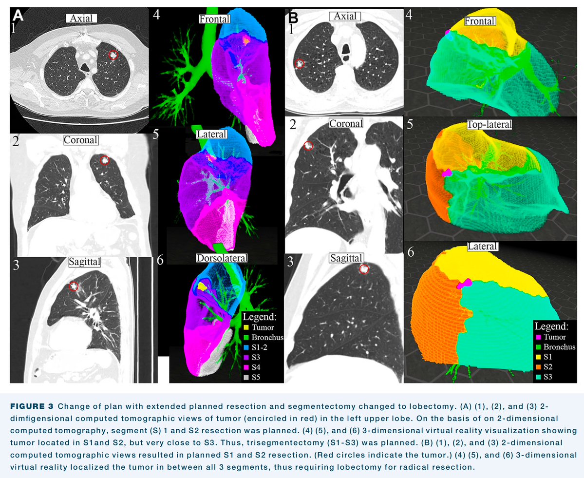 DrewMoghanaki's tweet photo. Thoracic surgery is starting to look more and more like radiation therapy. @drcoronacruz @BrendonStilesMD https://t.co/lhNAytnceE https://t.co/NRgB2s0LAX