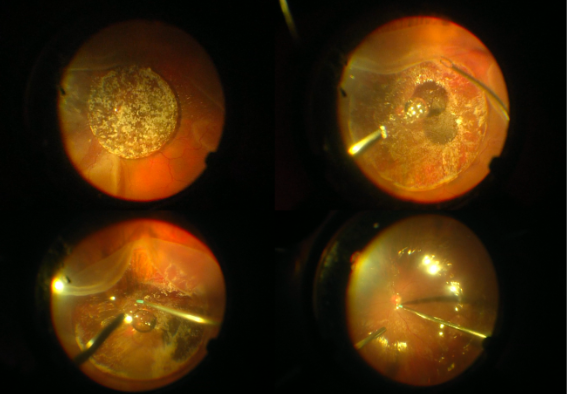 RetinaSERV's tweet photo. El manejo de desgarros retinianos gigantes es complicado. El cerclaje escleral junto a la vitrectomía solo es efectivo en pacientes pediátricos, debido a la dificultad de afeitar la base del vítreo, desprender la hialoides posterior y posicionar correctamente en este grupo. https://t.co/AxMWT5GXTH