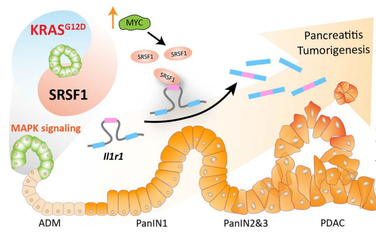 CD_AACR's tweet photo. Splicing Factor SRSF1 Promotes #Pancreatitis and #KRAS G12D-Mediated #PancreaticCancer— by @LedongW, Adrian Krainer et al.
https://t.co/VTmKsASnYv
@CSHL https://t.co/MtmY4KTPvs