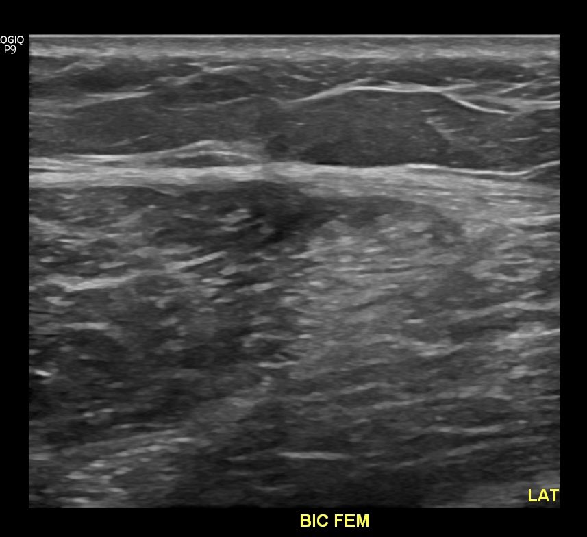 ZachBailowitzMD's tweet image. Nice example from clinic this week. Long head biceps femoris “T junction” injury, appears to be mostly a myofascial injury. Come learn more about muscular injury patterns and return to play with @WesTroyerDO and me on Monday morning at #amssm2023 #bamic