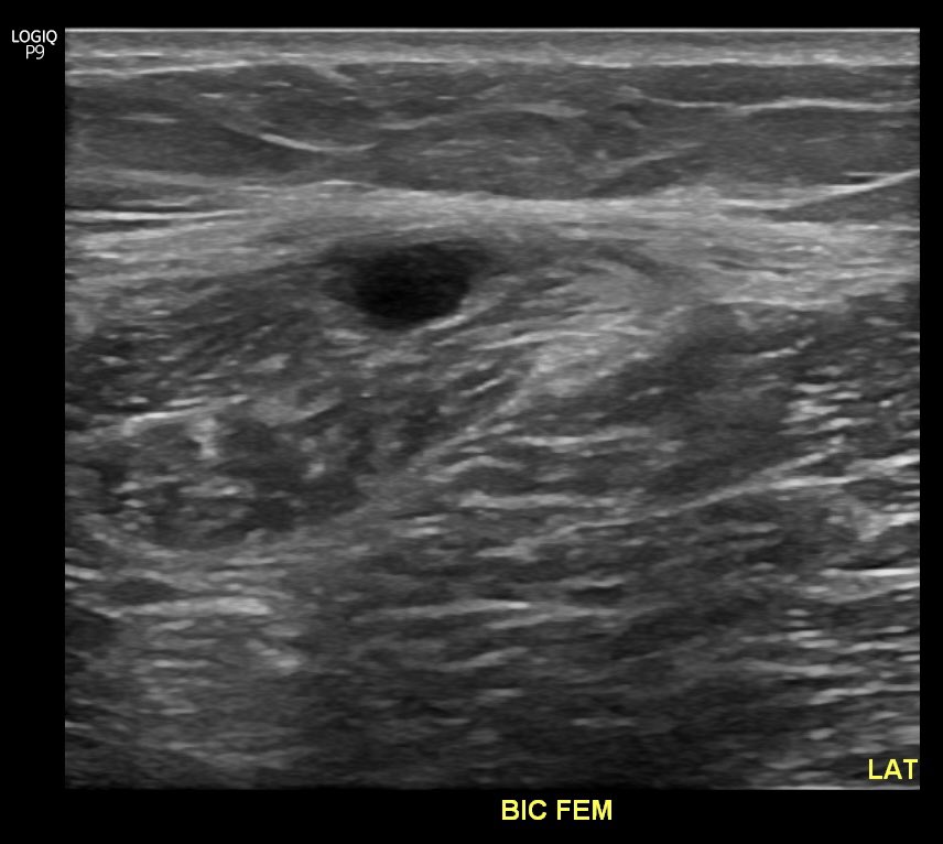 ZachBailowitzMD's tweet image. Nice example from clinic this week. Long head biceps femoris “T junction” injury, appears to be mostly a myofascial injury. Come learn more about muscular injury patterns and return to play with @WesTroyerDO and me on Monday morning at #amssm2023 #bamic