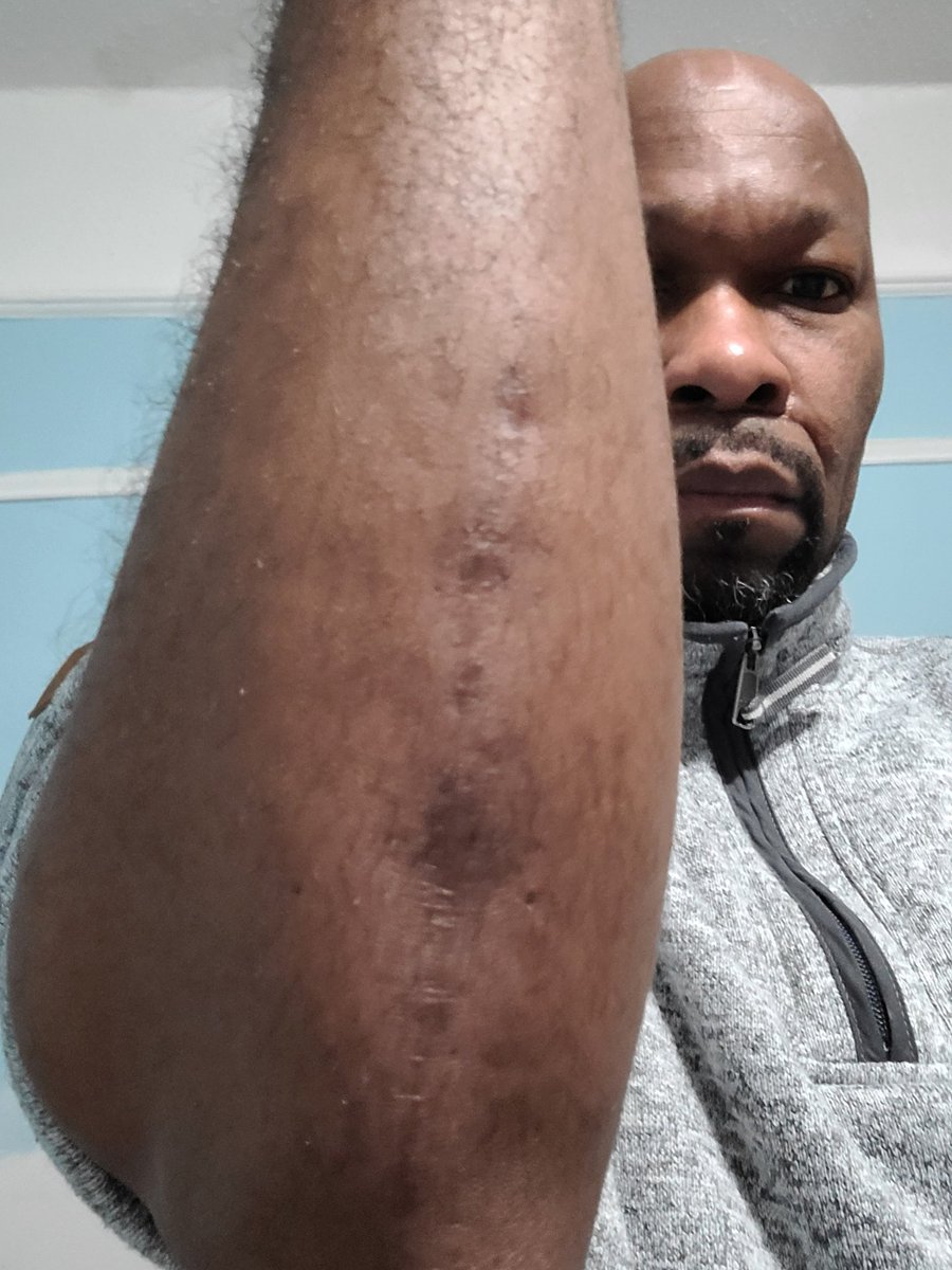 BrettAScudder's tweet photo. Awakened with attitude of humility/gratitude for breath of new day. Rough/long/complicated surgery yesterday @NYCHealthSystem North Central Bronx Hospital. Got in 7am, left 7pm. Great Orthopedic surgeon spent 5hrs fixing arm. Grateful 🙏 Now painful healing begins. #IAmBrettless https://t.co/uqNAjtOSiG