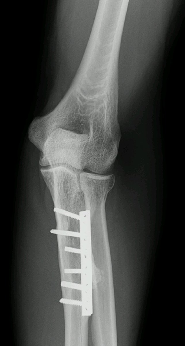 BrettAScudder's tweet photo. Awakened with attitude of humility/gratitude for breath of new day. Rough/long/complicated surgery yesterday @NYCHealthSystem North Central Bronx Hospital. Got in 7am, left 7pm. Great Orthopedic surgeon spent 5hrs fixing arm. Grateful 🙏 Now painful healing begins. #IAmBrettless https://t.co/uqNAjtOSiG