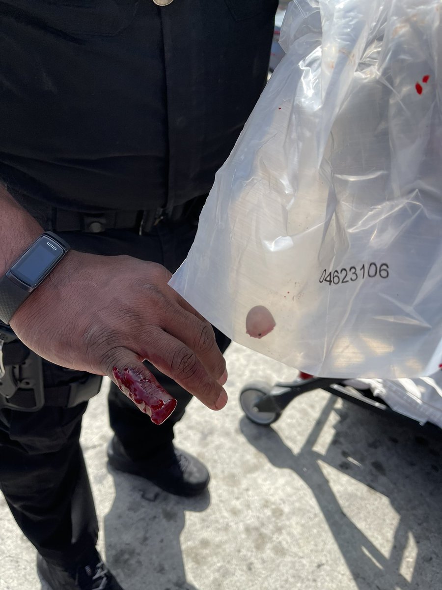 BillMelugin_'s tweet photo. WARNING GRAPHIC: Per law enforcement sources, a LAPD sergeant had part of his finger bit off by a violent transient at a Red Line Metro station in Hollywood earlier today. I’m told the sergeant saw him with a meth pipe &amp; confronted him. 
Photo courtesy: streetpeopleoflosangeles https://t.co/jNmpeLCAht