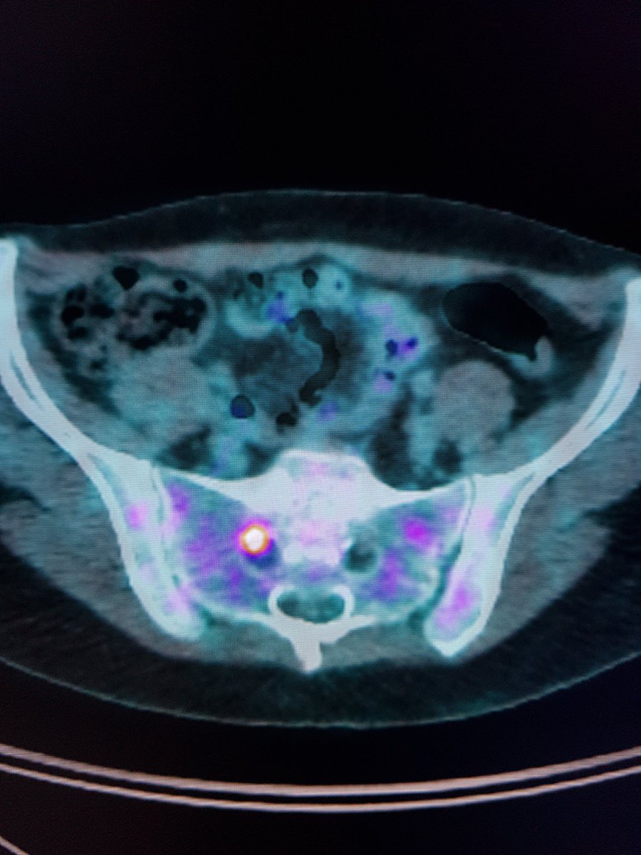 Jônatas Fávero (@jonatasfavero) on Twitter photo ▶️NH Lymphoma
▶️Thickening and avid FDG uptake along sacral nerve roots in keeping with neurolymphomatosis
▶️Take a look at another #AJNRcom from our hospital
<a href="/aline_spader/">Aline Spader</a> <a href="/SchuchAlice/">Alice Schuch</a> <a href="/JournalofNucMed/">JNM</a> <a href="/TheAJNR/">AJNR</a> <a href="/CasesCookyJar/">Cases From the Cooky Jar</a> <a href="/Felipegaliza/">Felipe de Galiza</a> <a href="/DrMHofman/">Michael Hofman</a> <a href="/francisdeng/">Francis Deng, MD</a> <a href="/teachplaygrub/">Lea Alhilali, MD</a> ▶️NH Lymphoma
▶️Thickening and avid FDG uptake along sacral nerve roots in keeping with neurolymphomatosis
▶️Take a look at another #AJNRcom from our hospital
<a href="/aline_spader/">Aline Spader</a> <a href="/SchuchAlice/">Alice Schuch</a> <a href="/JournalofNucMed/">JNM</a> <a href="/TheAJNR/">AJNR</a> <a href="/CasesCookyJar/">Cases From the Cooky Jar</a> <a href="/Felipegaliza/">Felipe de Galiza</a> <a href="/DrMHofman/">Michael Hofman</a> <a href="/francisdeng/">Francis Deng, MD</a> <a href="/teachplaygrub/">Lea Alhilali, MD</a>