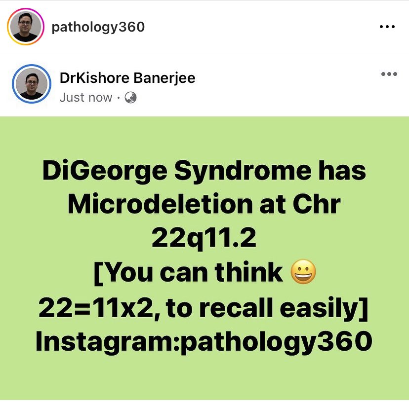 #DiGeorgeSyndrome :  characterized by micro deletion at Chromosome 22 ( 22q11.2). You can think this as 22= 11x2 😁or, 22=11.2 ). In this syndrome, there is 🔑defective development of the third and fourth pharyngeal pouches leading to hypoplastic thymus and parathyroid.