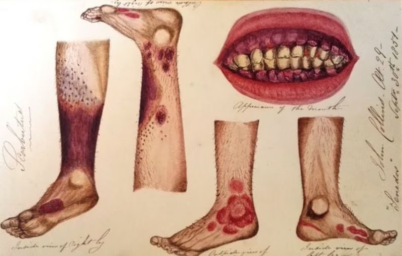 najlabio's tweet photo. 📌 ثريد

من اوائل الدراسات السريرية المحكمة على الإطلاق controlled clinical trial 👥💊

تجربة علاج مرض الإسقربوط Scurvey للطبيب جيمس لند James Lind عام 1747م

#الصحه_العامه
#تجارب_سريرية https://t.co/SjmeYcBNTI