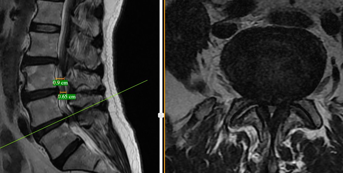 shriram_shri86's tweet photo. 💡Multi-level changes with mid-vertebral narrowing - primary stenosis &amp; accelerated secondary degeneration rx segmental decompression &amp; stabilisation/fixation #vebinars #value_based_imaging #evidence_based_practice #neurorad #FOAMrad #neurology #neurosurgery #radres #NeuroTwitter https://t.co/vv28EXSazT