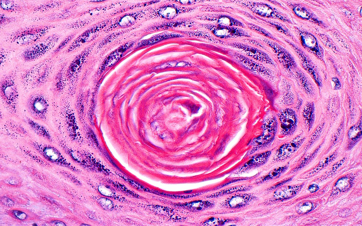 ziad_zaatari's tweet photo. A Swirl ~ Keratin and Granulosum  #PathArt 
#dermpath #histology https://t.co/HXzs14yKxJ